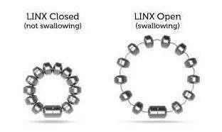 Χειρουργική μέθοδος LINX
